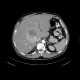 Liver metastases of carcinoid, embolization: CT - Computed tomography